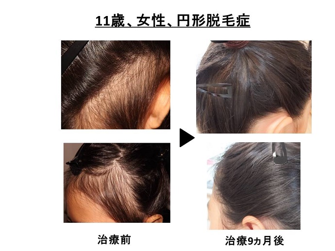 円形脱毛症　病院